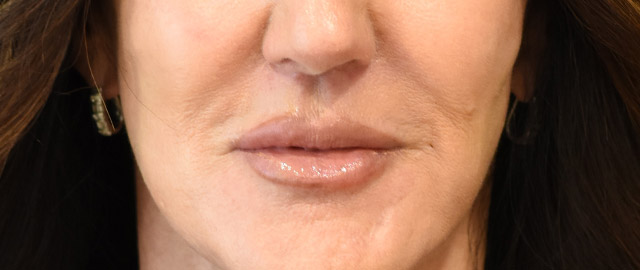 Lip Lift Patient 17 Set 1 After