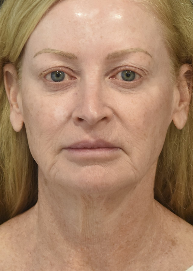 Deep Plane Facelift Patient 42 Set 1 Before
