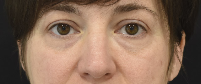 Eyelid Surgery Patient 30 Set 1 Before