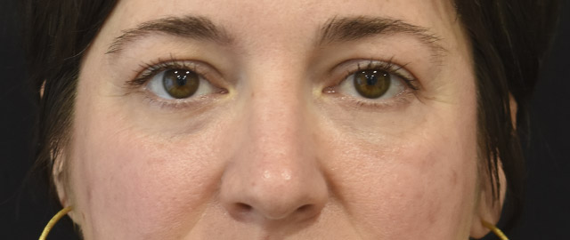 Eyelid Surgery Patient 30 Set 1 After